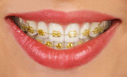 gold-braces